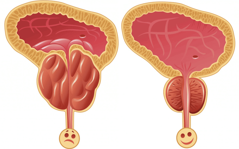 vyrų potencijos problemų priežastys